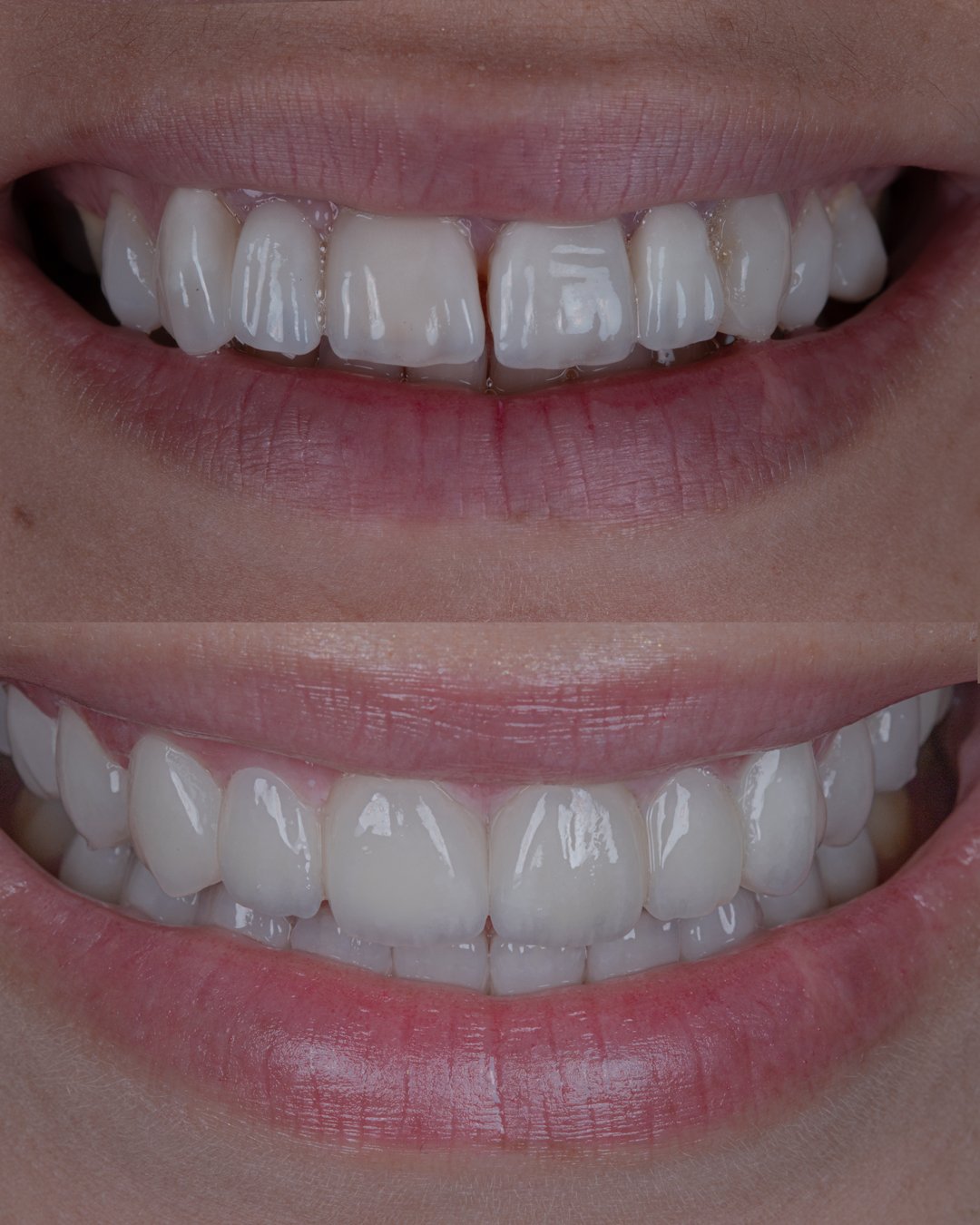 Documentación clínica de alta estética por la Dra. Lina Bedoya: La imagen superior muestra un frente estético con diastema central, irregularidades en los bordes incisales y una textura dental plana. La imagen inferior presenta la rehabilitación final con carillas de cerámica estratificada, logrando el cierre de espacios, una alineación perfecta y un borde incisal con translucidez natural y efecto de halo opalescente.