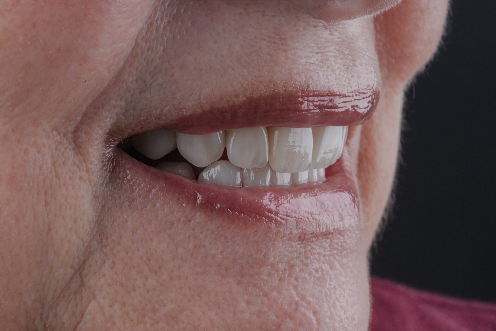 Macrofotografía lateral del resultado final destacando el brillo y la integración de las coronas de disilicato de litio de la Dra. Lina Bedoya.