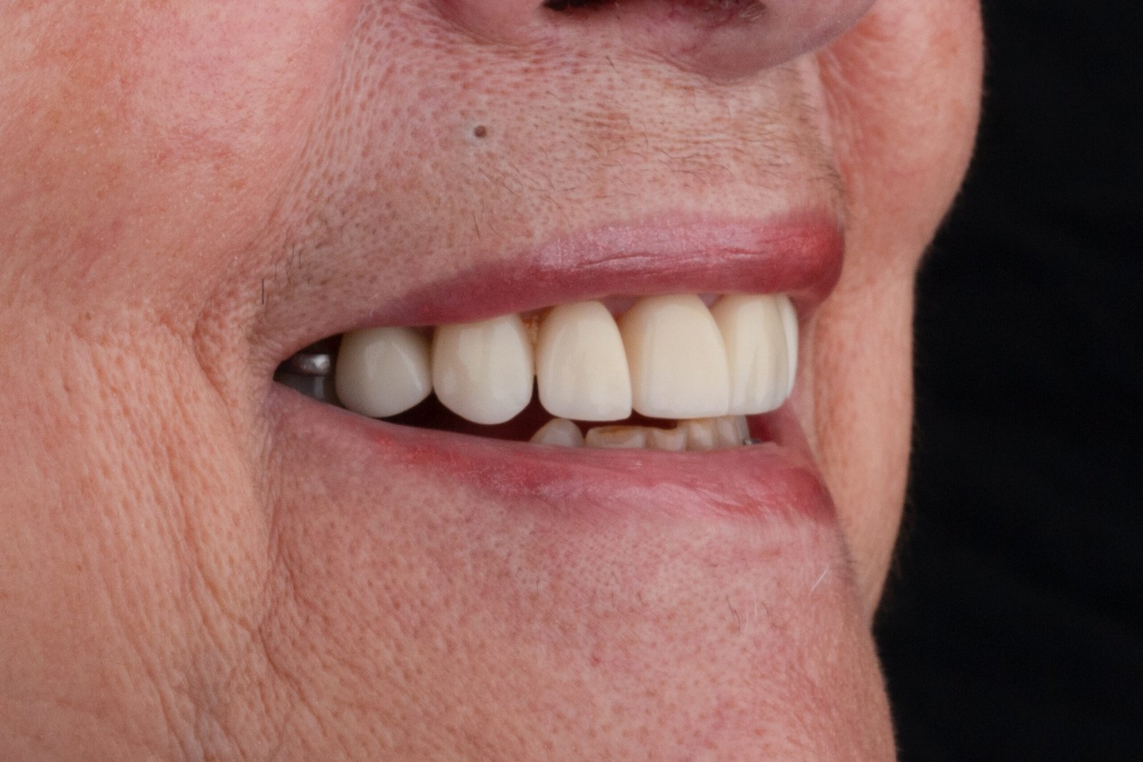 Perfil lateral inicial que muestra el desajuste de las coronas antiguas y la presencia de espacios interdentales antes de la intervención de la Dra. Lina Bedoya.