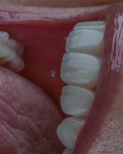 detalle de mimetismo y traslucidez en cerámica estratificada por la dra. lina bedoya