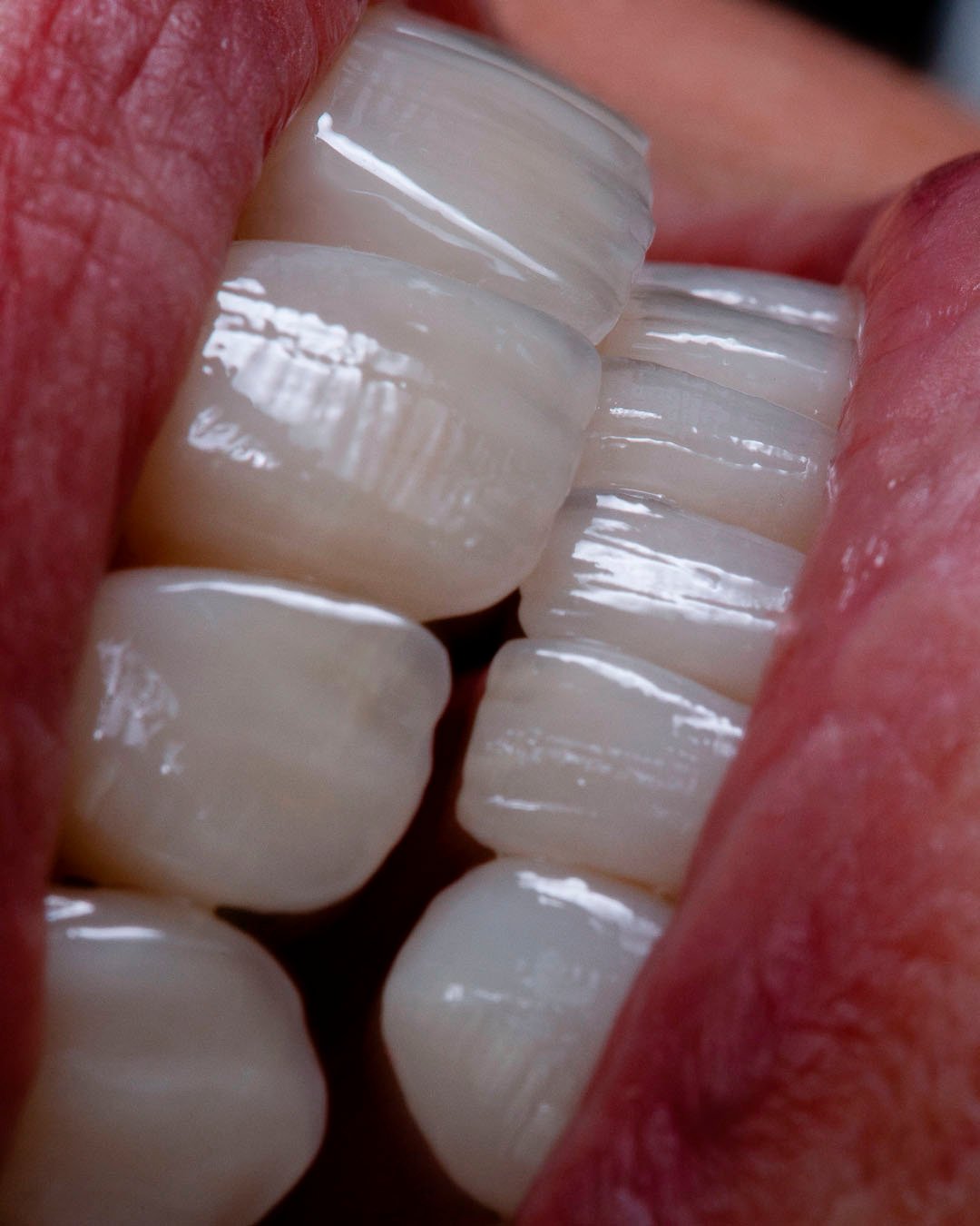 Macrofotografía del resultado final mostrando la textura detallada y traslucidez del disilicato de litio estratificado por la Dra. Lina Bedoya.