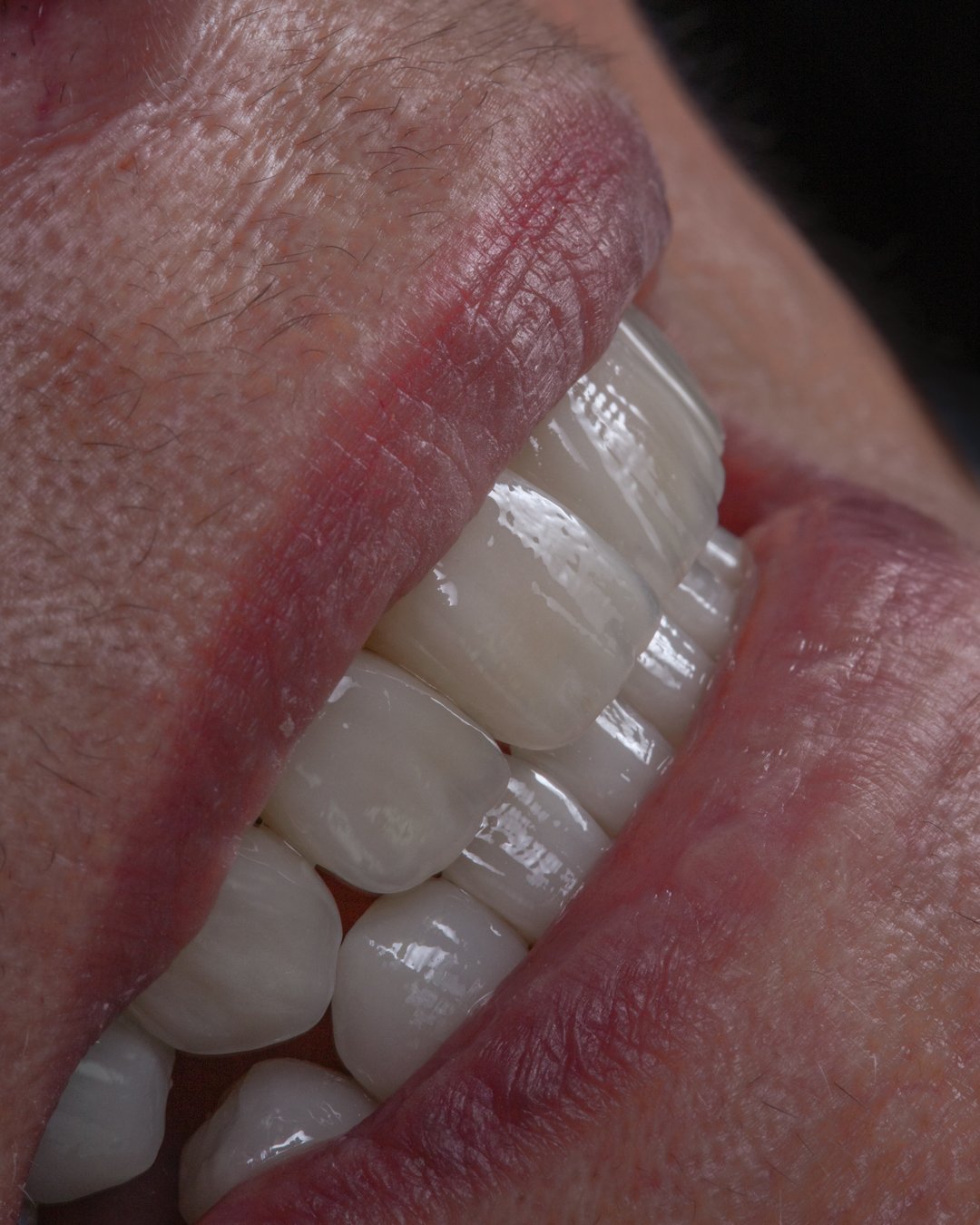 Resultado final en vista lateral que muestra el cierre total de diastemas y la nueva proyección estética lograda por la Dra. Lina Bedoya.