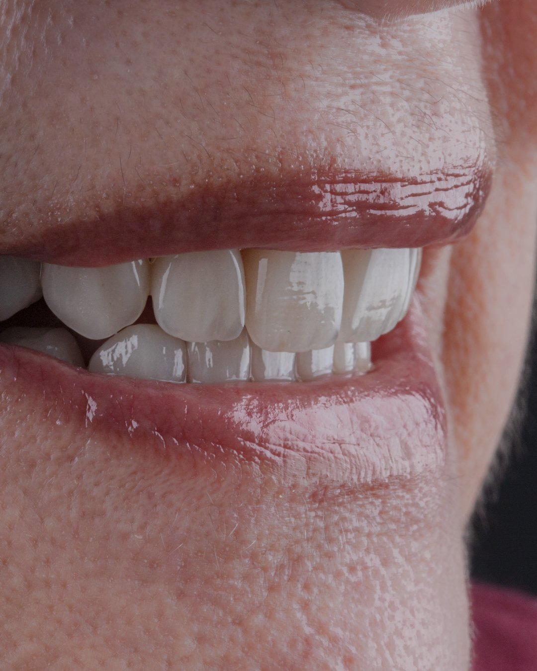 Macrofotografía lateral del resultado final destacando el brillo y la integración de las coronas de disilicato de litio de la Dra. Lina Bedoya.