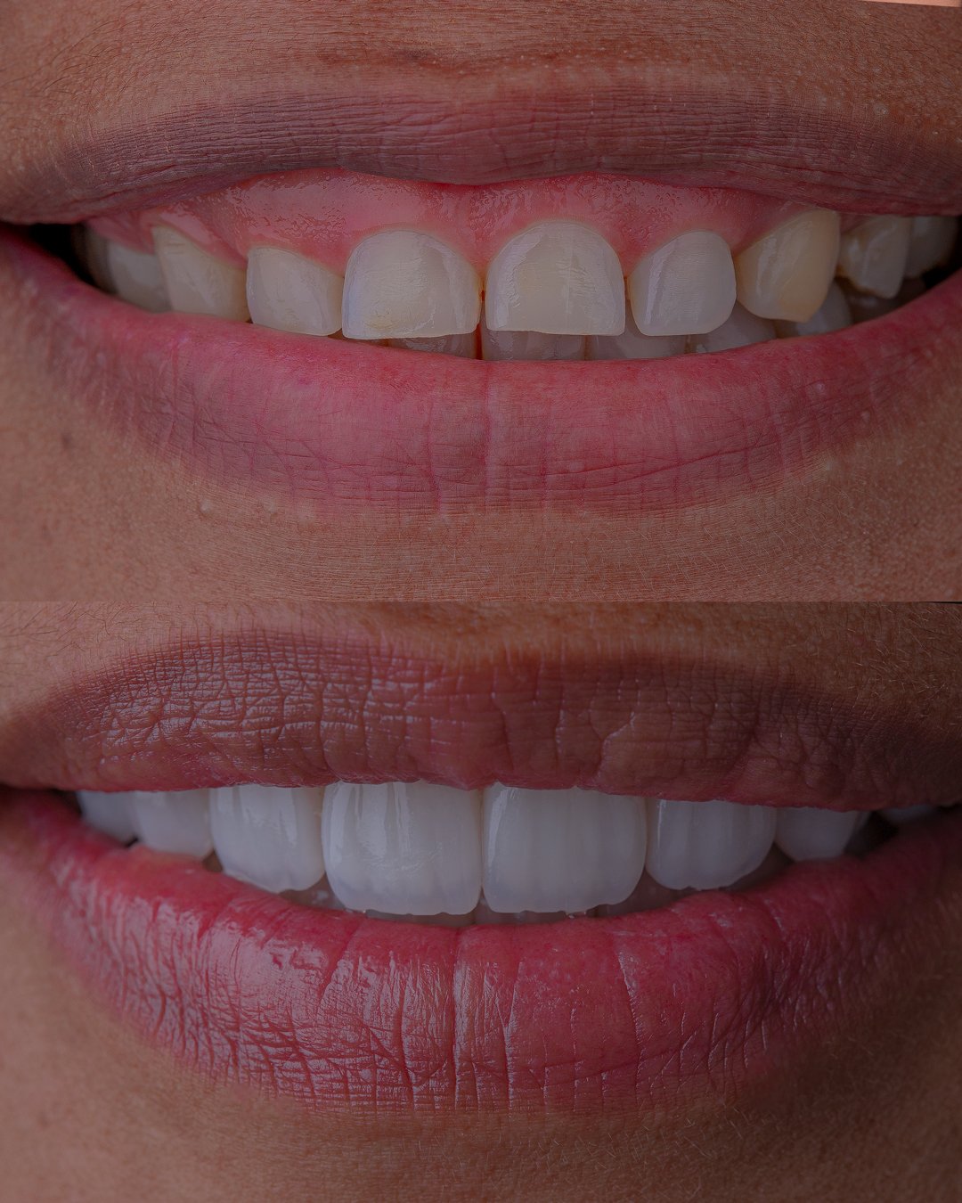 Detalle de transformación dental mediante carillas estratificadas realizadas por la Dra. Lina Bedoya.