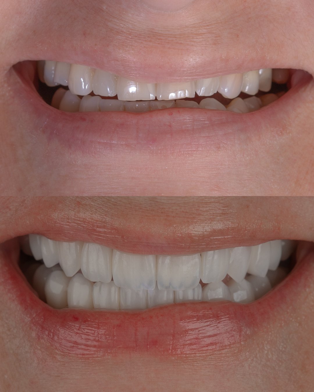 Vista oclusal inferior de carillas cerámicas realizadas por la Dra. Lina Bedoya. La imagen resalta el ajuste perfecto de las restauraciones, la anatomía palatina natural y la salud de la encía marginal.