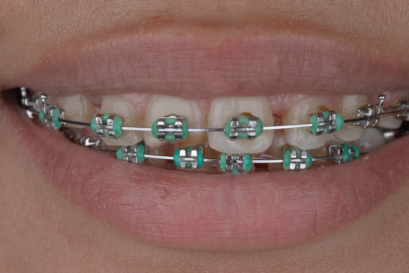 Registro fotográfico inicial de sonrisa con ortodoncia metálica y ligaduras, previo a la rehabilitación de anodoncia y estética dental realizada por la Dra. Lina Bedoya.