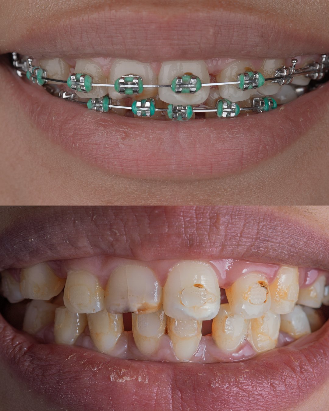 Comparativa clínica del Caso 12: Estado inicial con anodoncia y espacios frente a la fase de ortodoncia finalizada, previo a la rehabilitación con carillas de la Dra. Lina Bedoya.