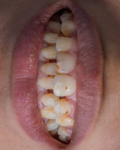 Detalle clínico intraoral que muestra la anatomía dental inicial con anodoncia y espacios interdentales, previo al tratamiento de alta estética de la Dra. Lina Bedoya.