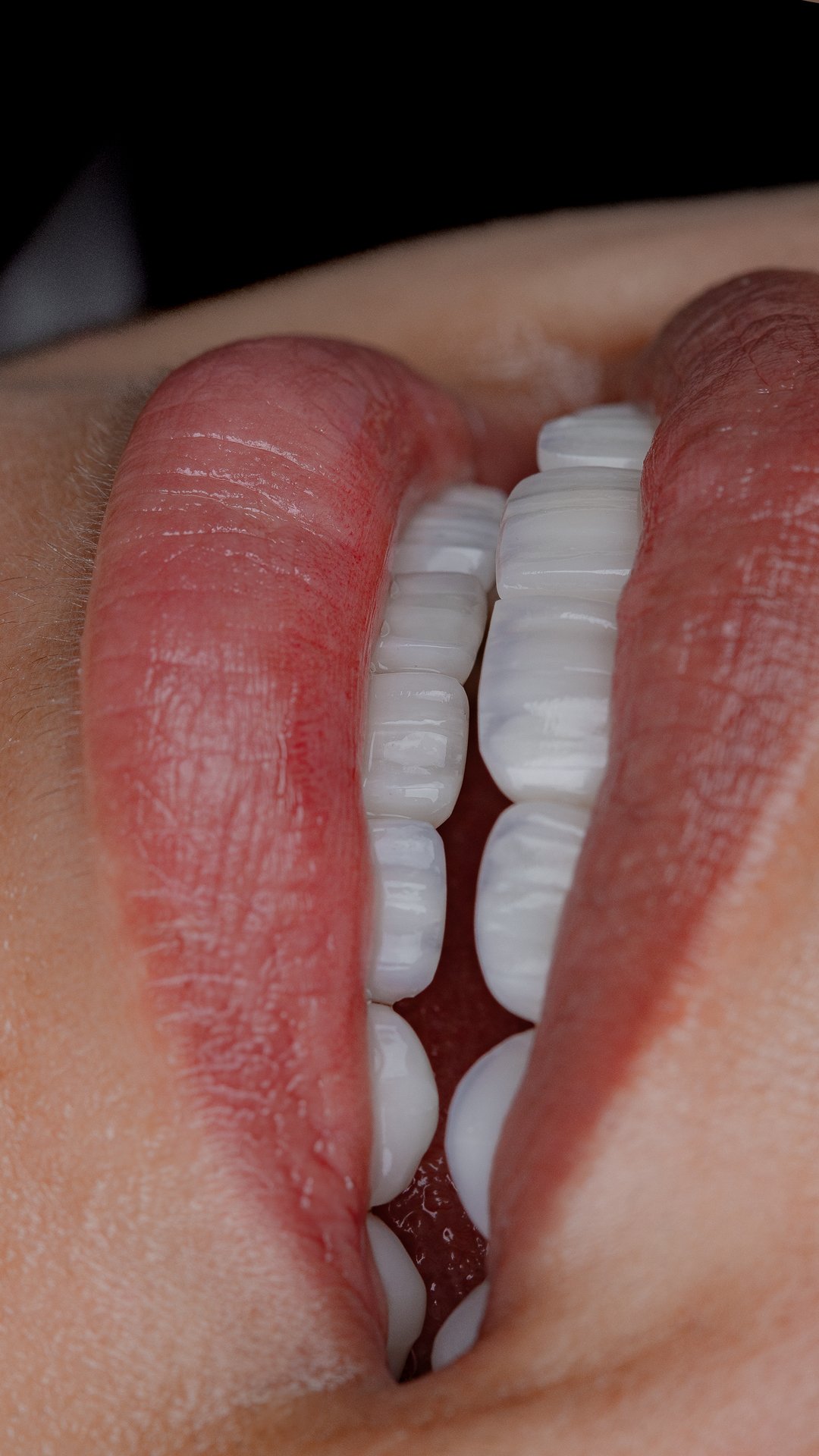 Vista desde el ángulo incisal que muestra la curvatura armónica y el acabado delgado de las carillas de porcelana diseñadas por la Dra. Lina Bedoya.