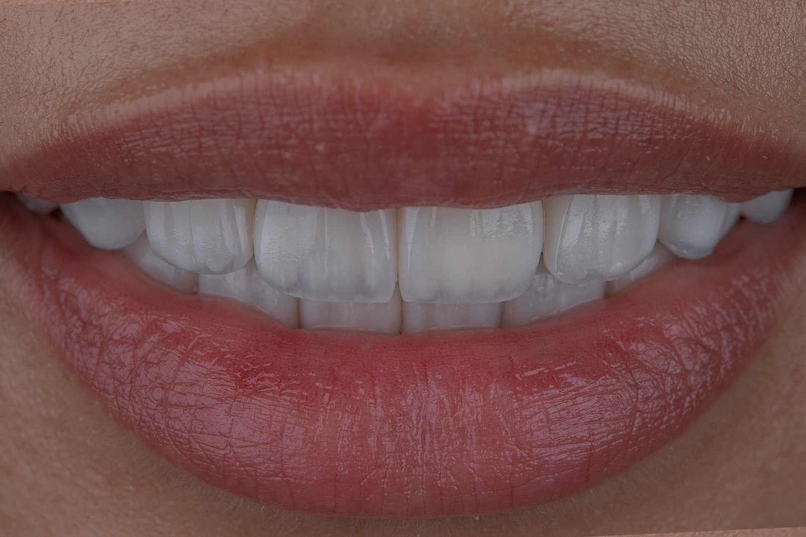 Resultado final de rehabilitación estética con carillas de porcelana para corregir anodoncia, logrando una sonrisa armónica y natural diseñada por la Dra. Lina Bedoya.