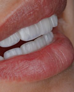 Detalle macro de carillas de porcelana que muestra la textura natural y la perfecta integración gingival del diseño de sonrisa realizado por la Dra. Lina Bedoya.