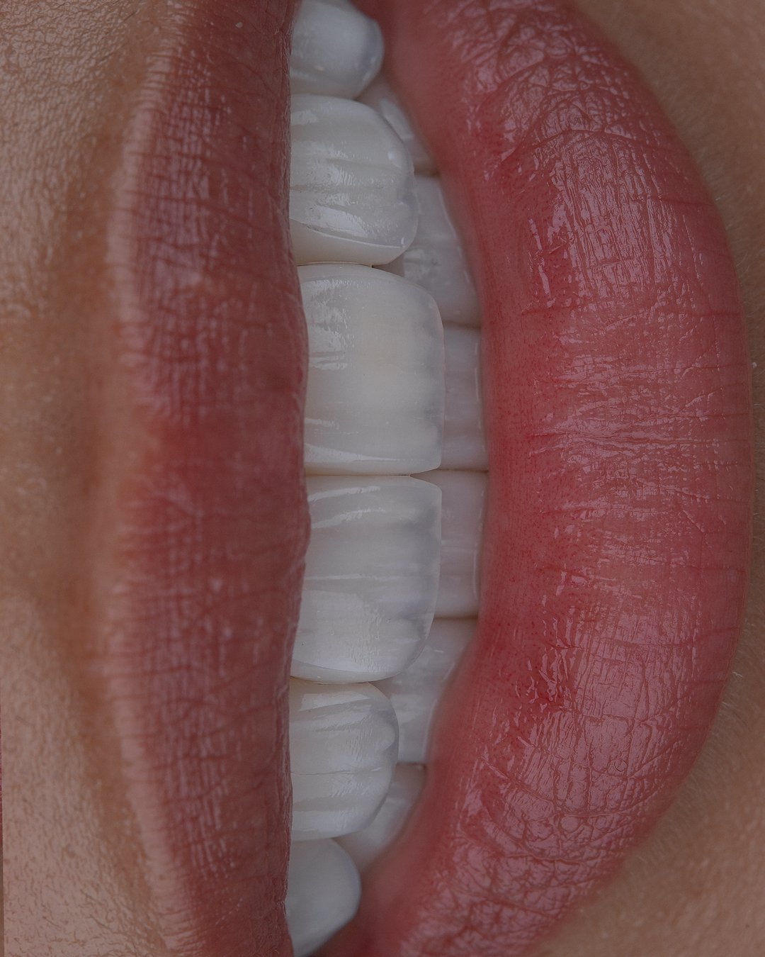 Vista frontal en encuadre vertical del resultado final: simetría y estética dental lograda con carillas de porcelana por la Dra. Lina Bedoya.