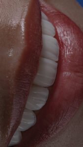 Detalle macro de carillas de porcelana que muestra la textura natural y la perfecta integración gingival del diseño de sonrisa realizado por la Dra. Lina Bedoya."