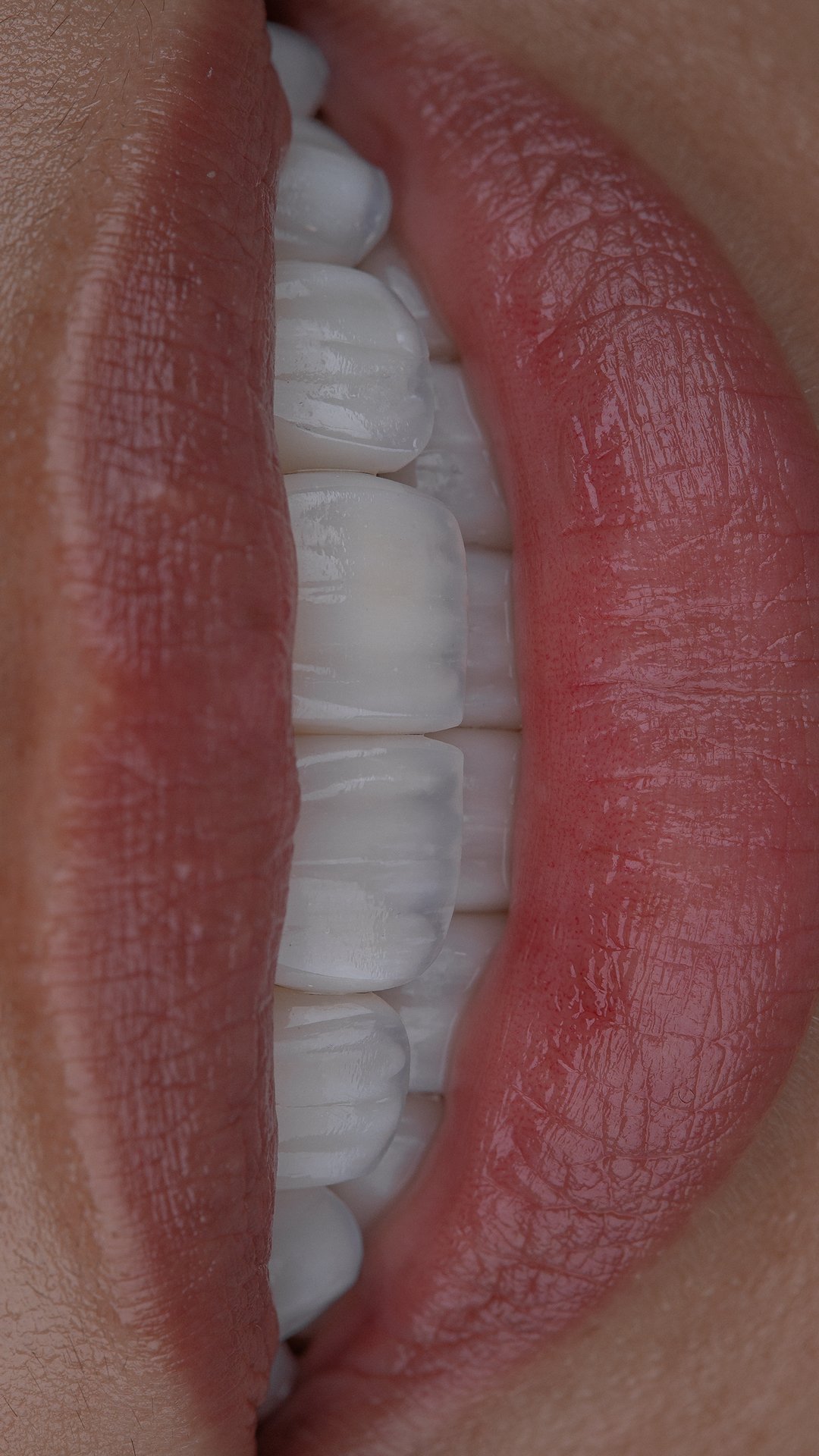 Primer plano que resalta el acabado pulido y la traslucidez natural de las carillas de porcelana, resultado del diseño de sonrisa de la Dra. Lina Bedoya.