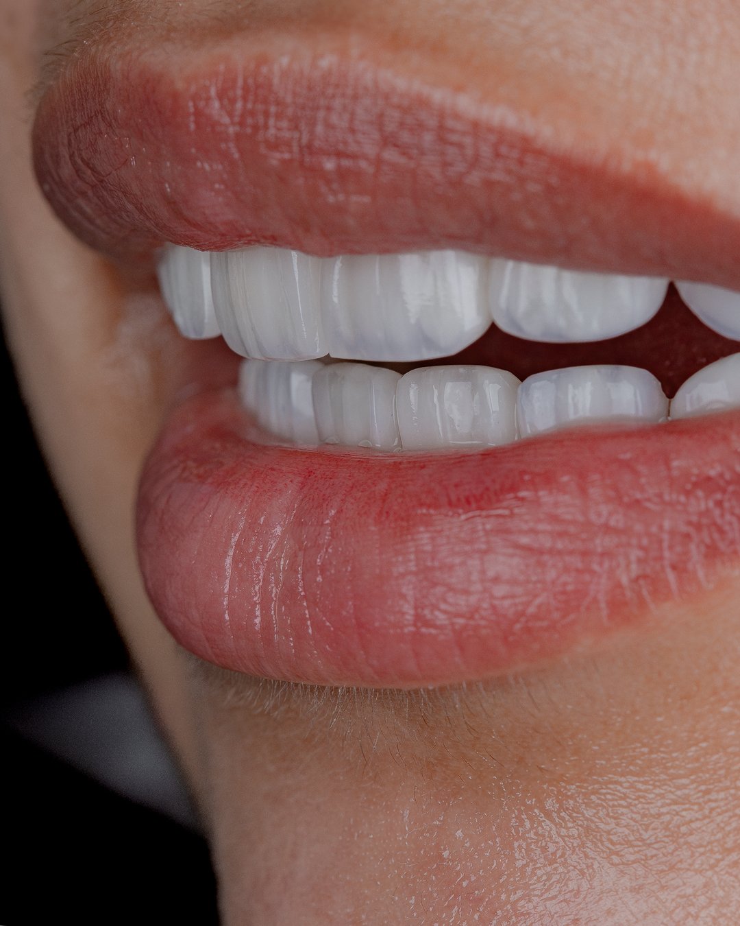 Vista de perfil del resultado final: integración natural de carillas de porcelana y armonía estética de la sonrisa diseñada por la Dra. Lina Bedoya.