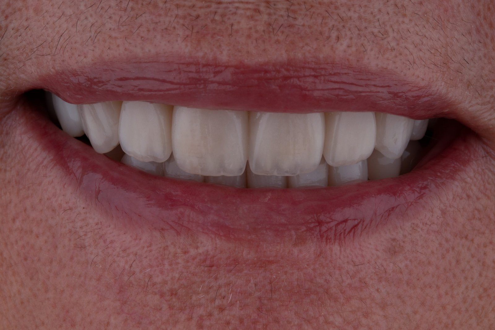 Resultado final de la sonrisa con cierre de diastemas y coronas en disilicato de litio estratificado realizadas por la Dra. Lina Bedoya.