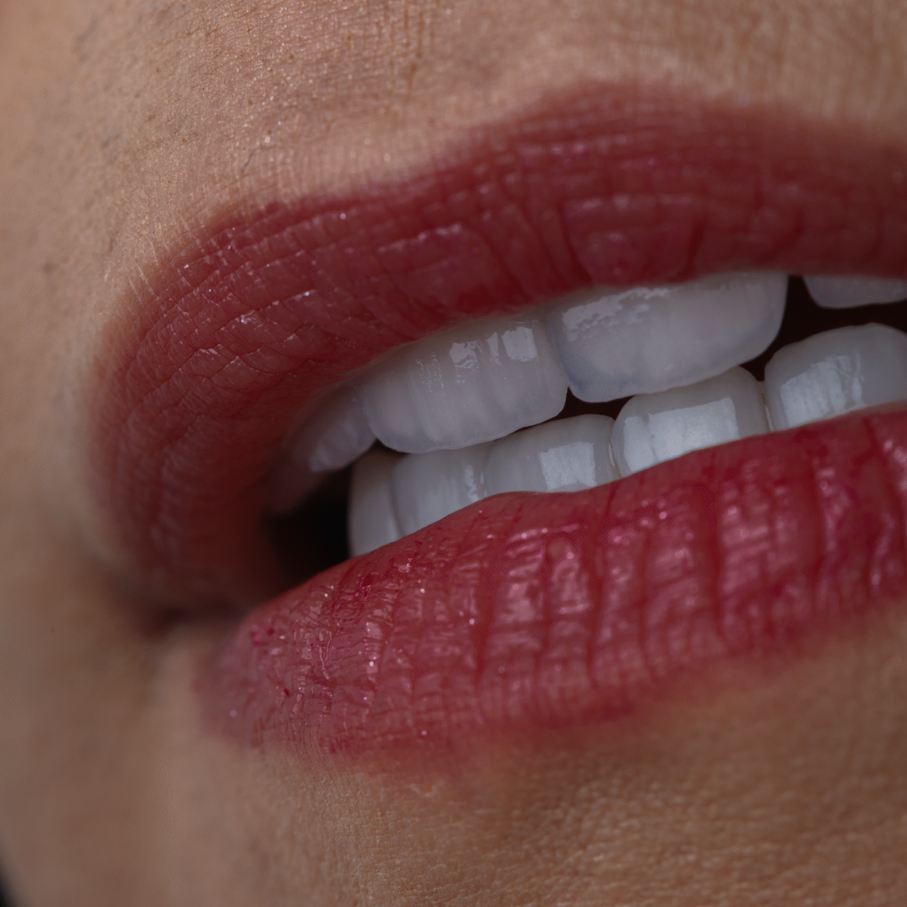 Resultados hermossos Carillas Ceramicas Dra Lina Bedoya